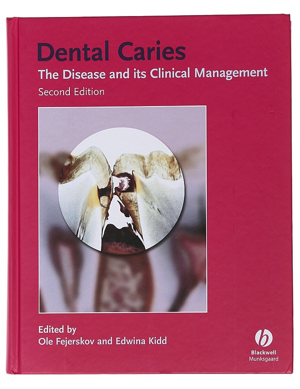 Dental Caries - The Disease and clinical Management  - Ole Fejerskov and Edwina Kidd - Tietokirjat ja oppaat - 10105482372 - 0