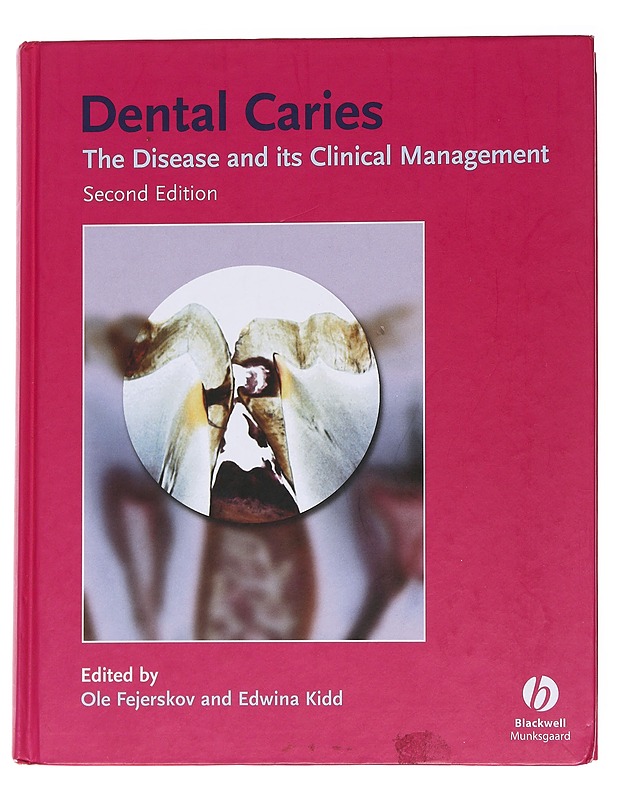 Dental Caries - The Disease and clinical Management - Tietokirjat ja oppaat - 10105562509 - 0